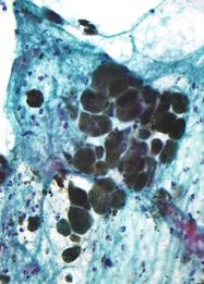 220px-pigmented_melanoma_-_cytology